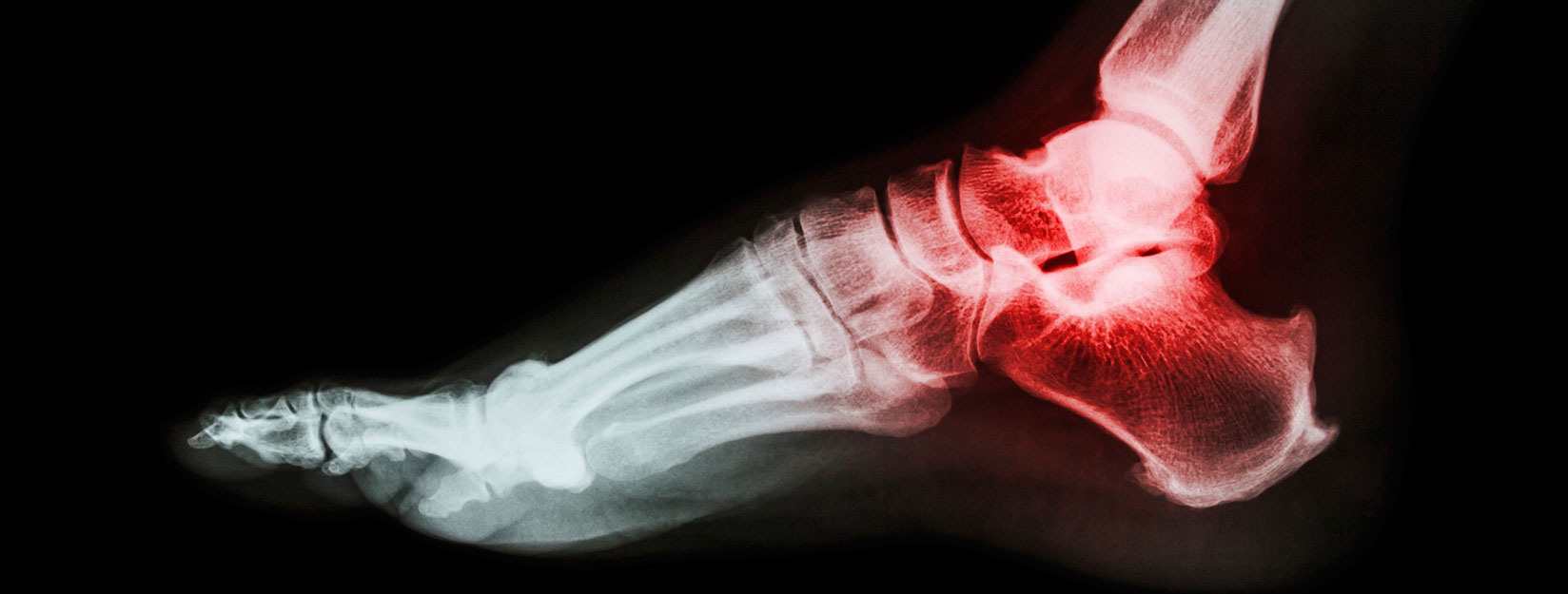 Esguince de tobillo: una lesión frecuente que se debe tratar